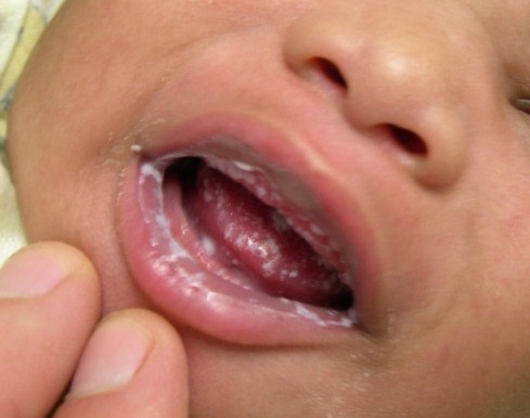 Bebeklerde ağız yaraları 1