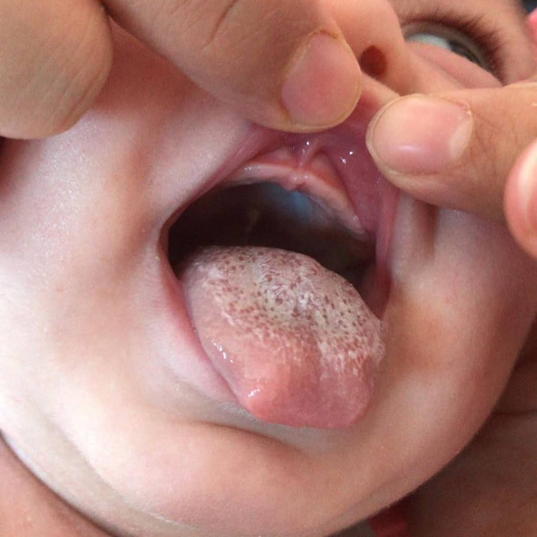 Bebeklerde ağız yaraları 2