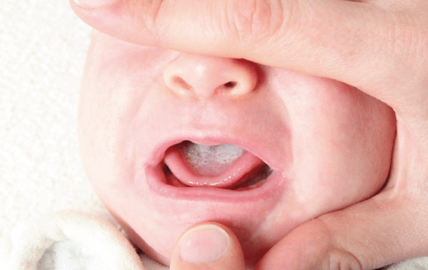 Bebeklerde ağız yaraları nasıl geçer 1